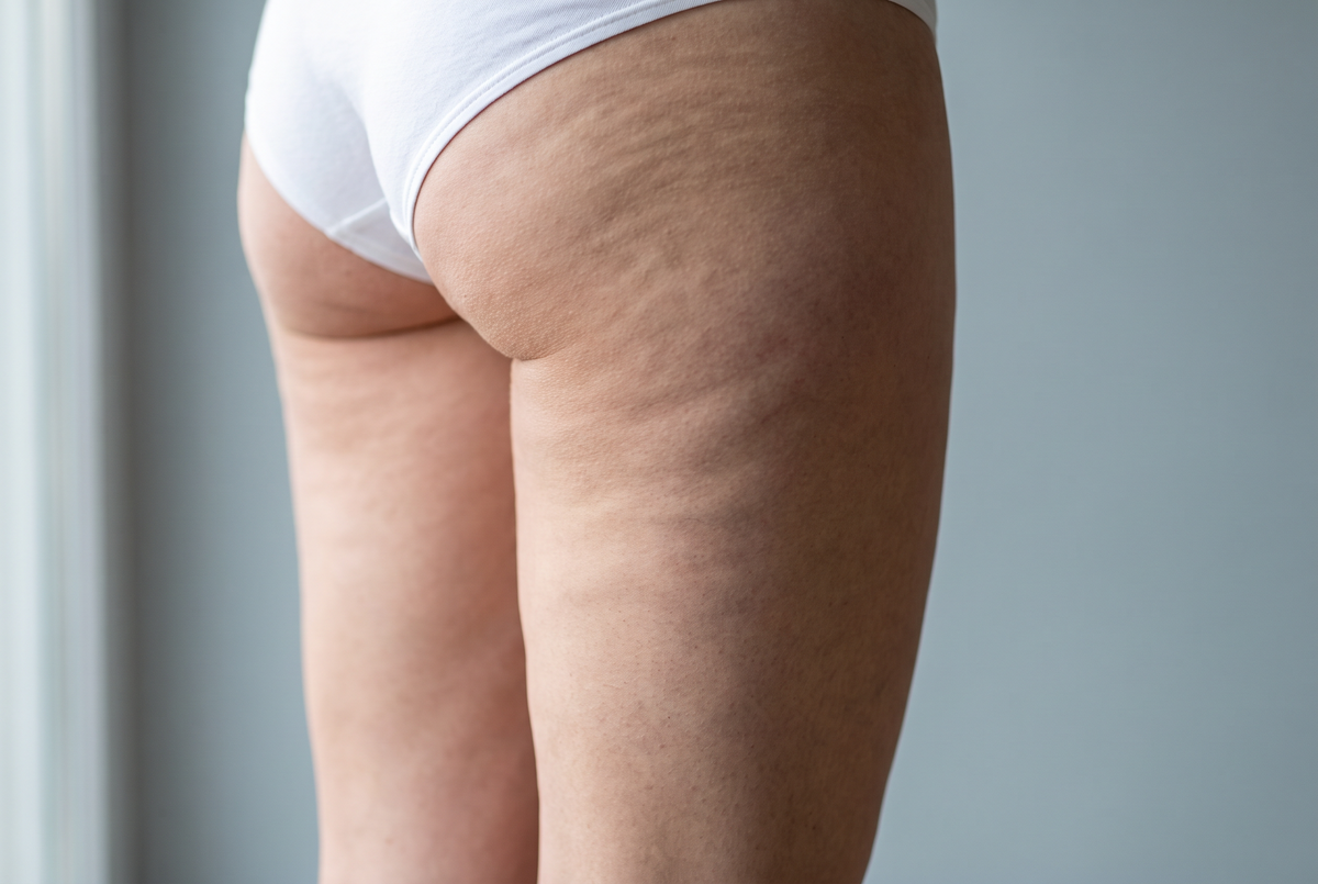 Prima: inestetismi della cellulite sulla coscia. Immagine illustrativa.