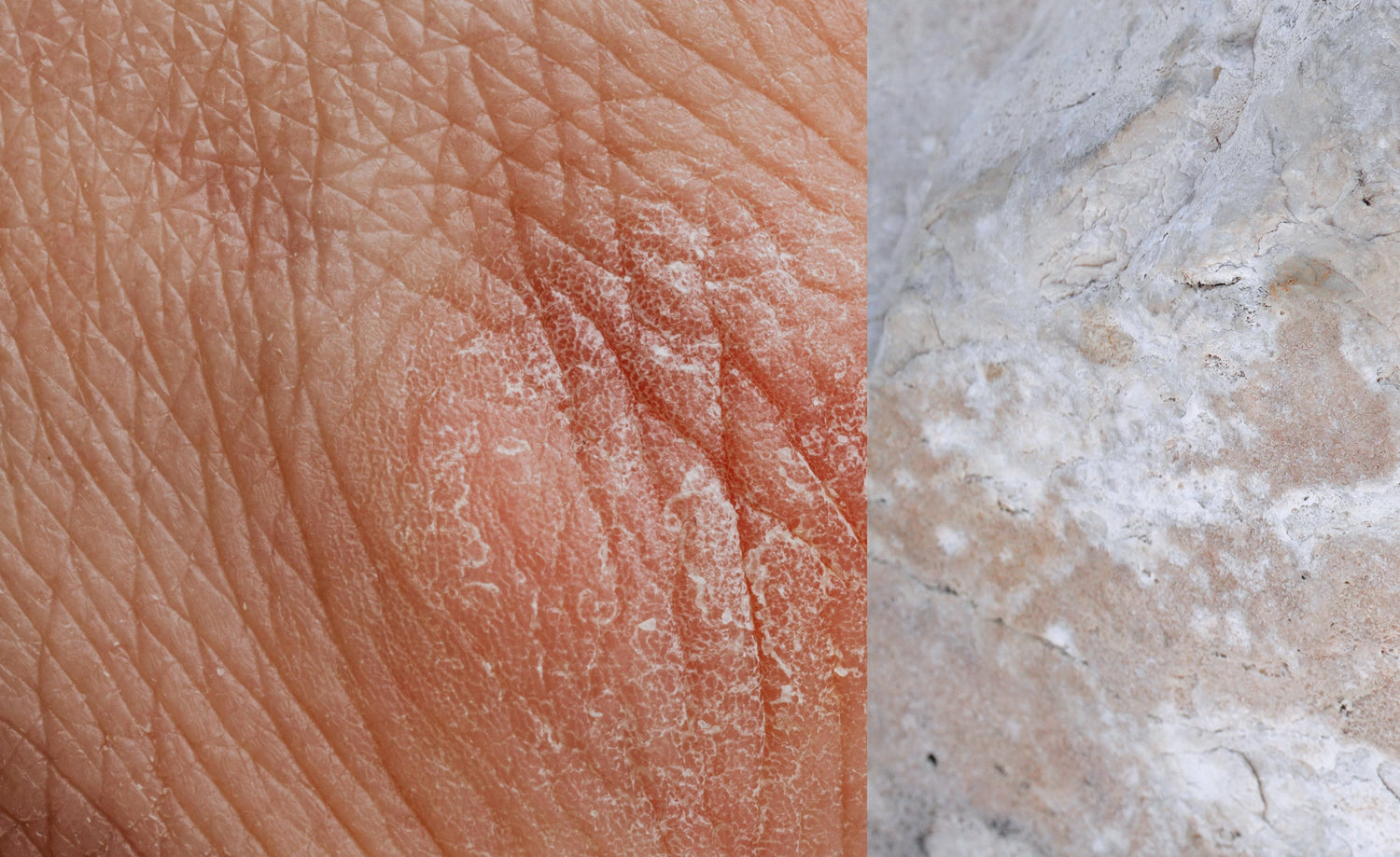 trattamento psoriasi e dermatiti